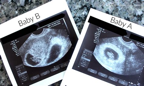 dating twin pregnancy by ultrasound